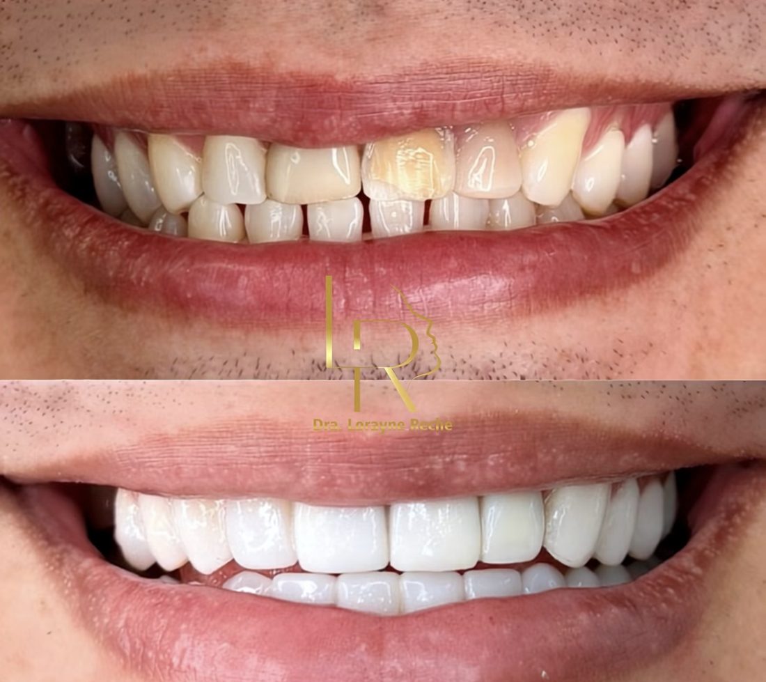 Antes e depois de lentes em resina composta