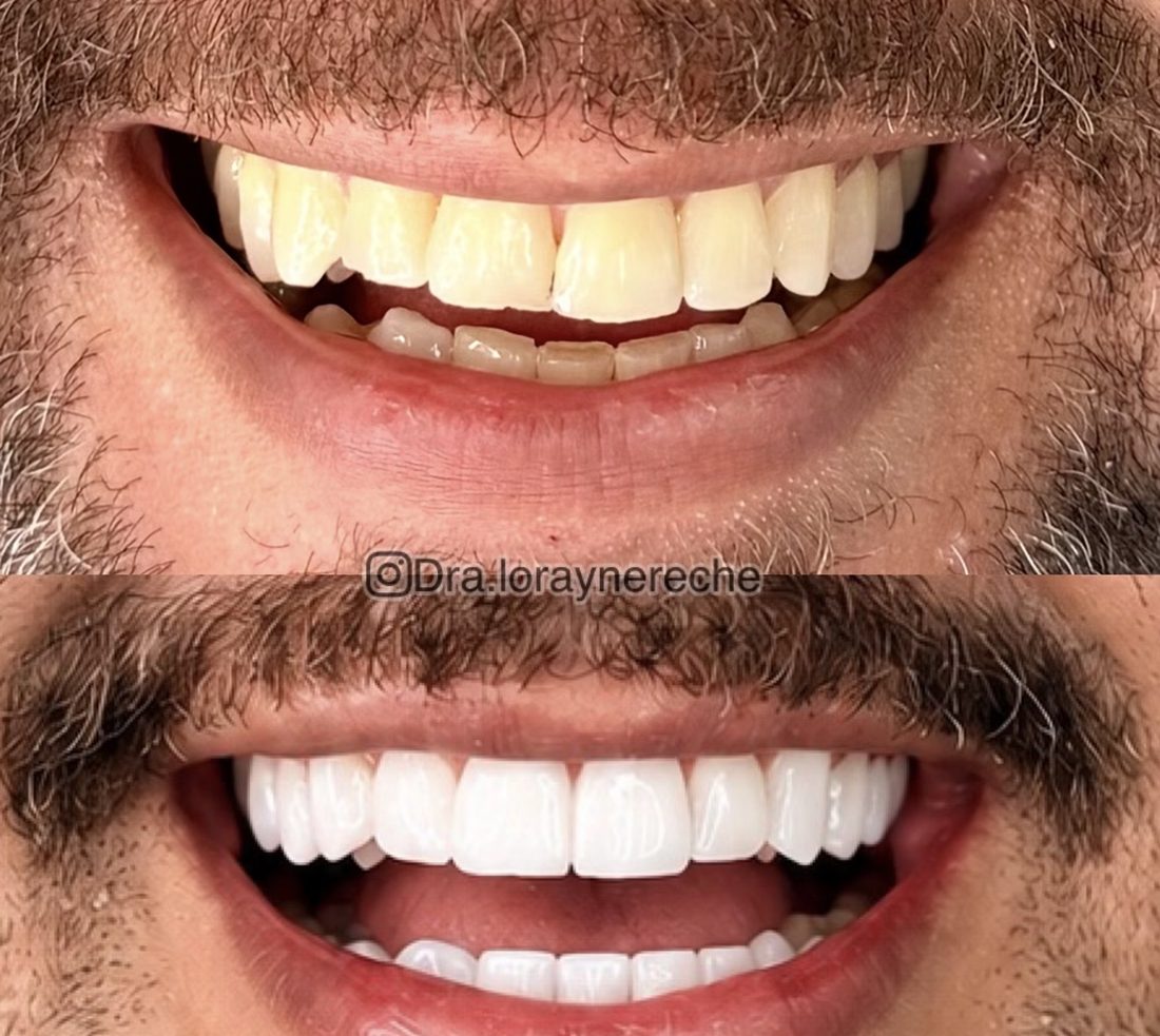 Antes e depois de lentes em resina composta