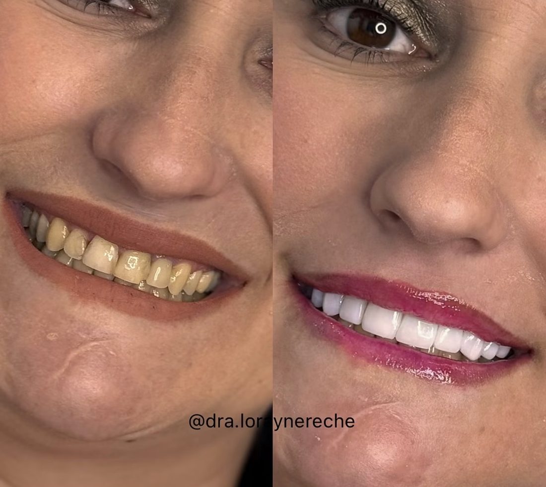 Antes e depois de sorriso feminino com lentes em resina