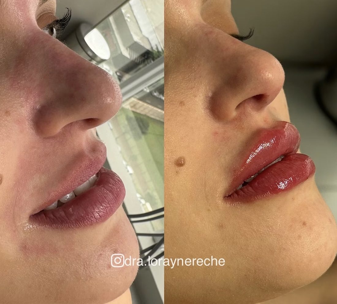 Antes e depois de preenchimento labial, de perfil