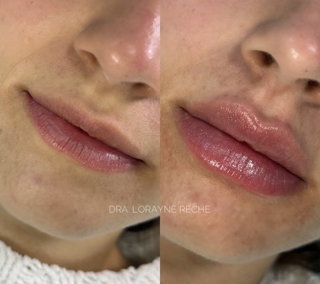 Antes e depois de preenchimento labial, vista frontal